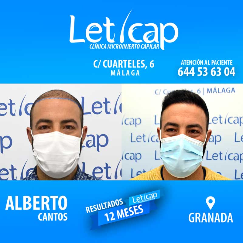 clinica capilar en Lanzarote antes y despues