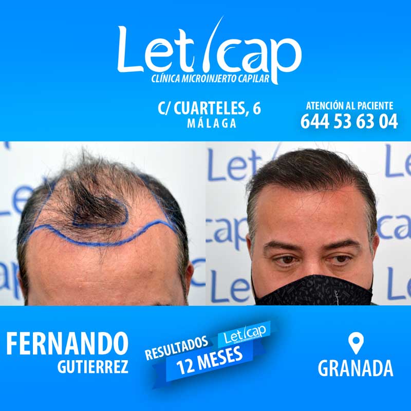 antes y despues hombre clinica capilar Lanzarote