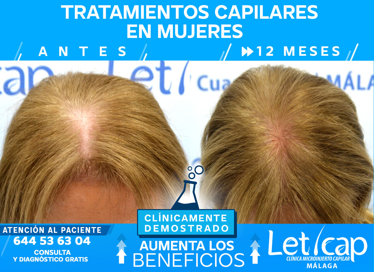 Tratamiento de mesoterapia capilar en Málaga